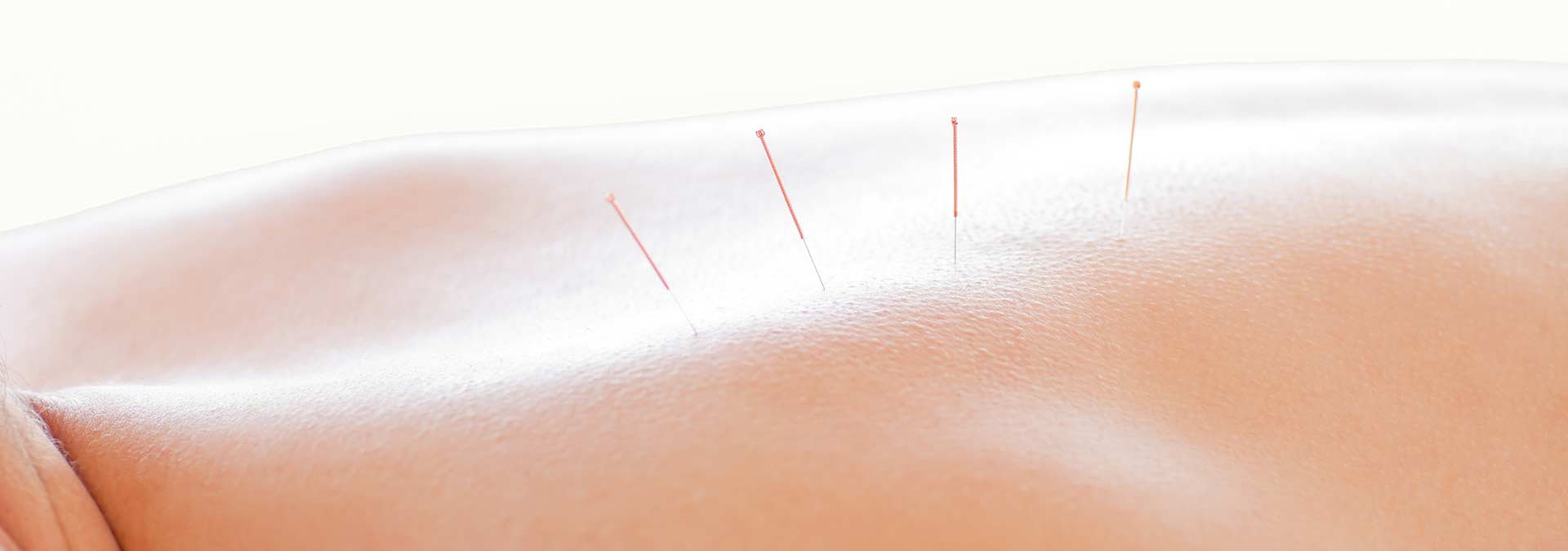 Acupuncture Calgary | Northern Hills Chiropractic | North Calgary AB