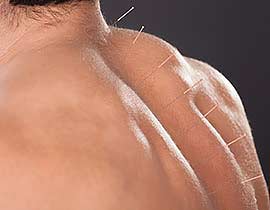 Acupuncture | Northern Hills Chiropractic | North Calgary Acupuncture